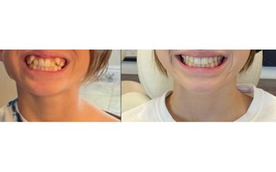 Emotional About My Son’s Braces Coming Off